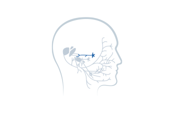 Stage 4: Geniculate Ganglion Injury