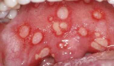 Behçet’s Disease
