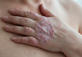 Psoriatic Arthritis (PsA)