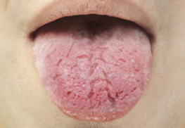 Sjögren’s Syndrome