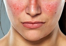 Systemic Lupus Erythematosus (SLE)