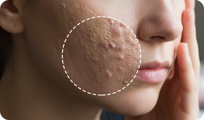 패인 흉터 피부 이미지